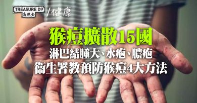 猴痘擴散15國　初步評估對港風險低　病徵包括淋巴結腫大 出水疱膿疱　衞生署教預防猴痘4大方法
